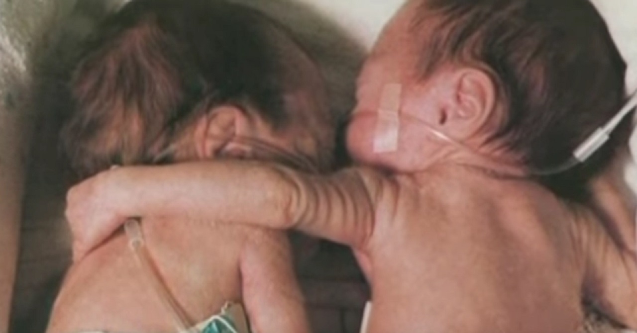 Un nouveau-n prmatur sauve la vie de sa soeur jumelle grce  l'initiative d'une infirmire